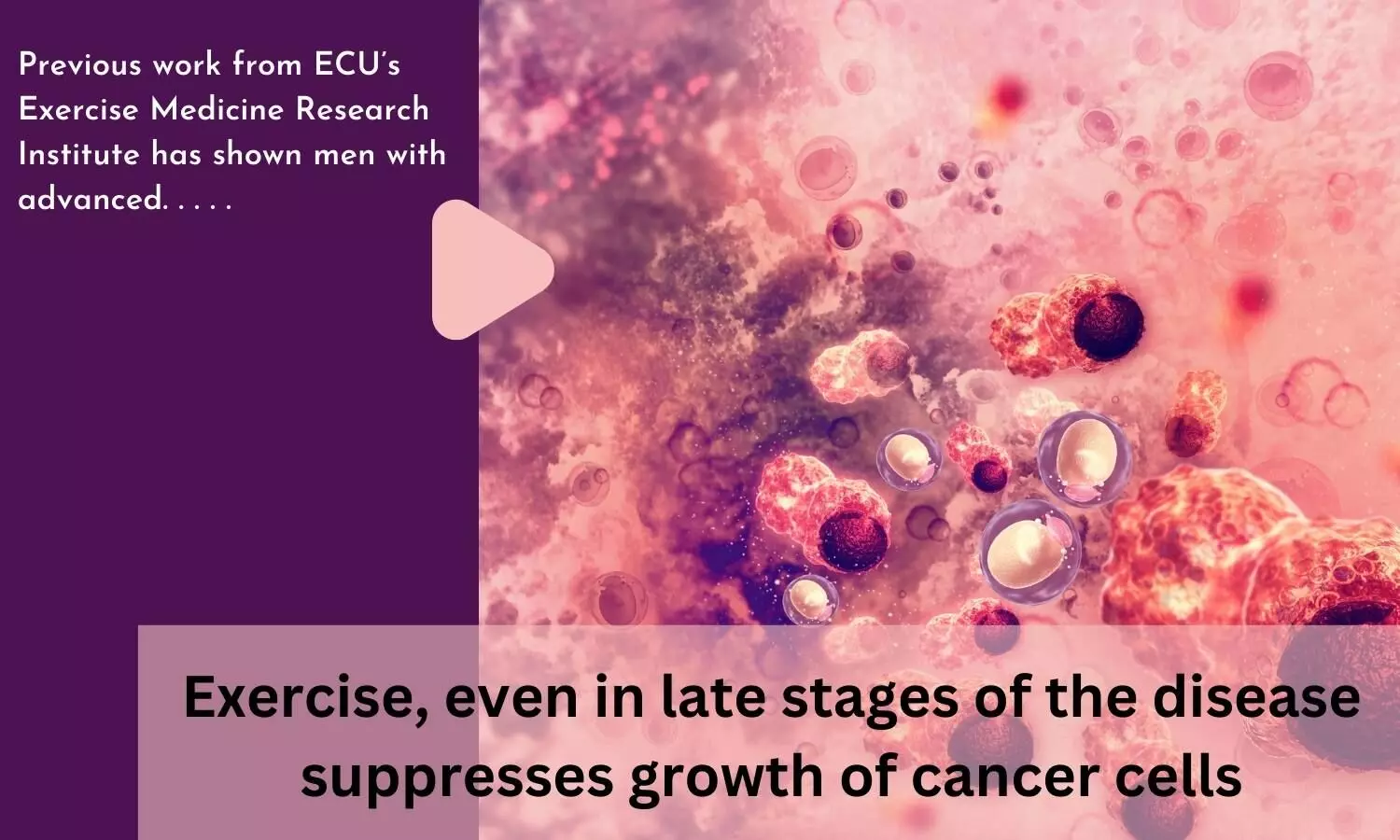 Exercise, even in late stages of the disease suppresses growth of cancer cells
