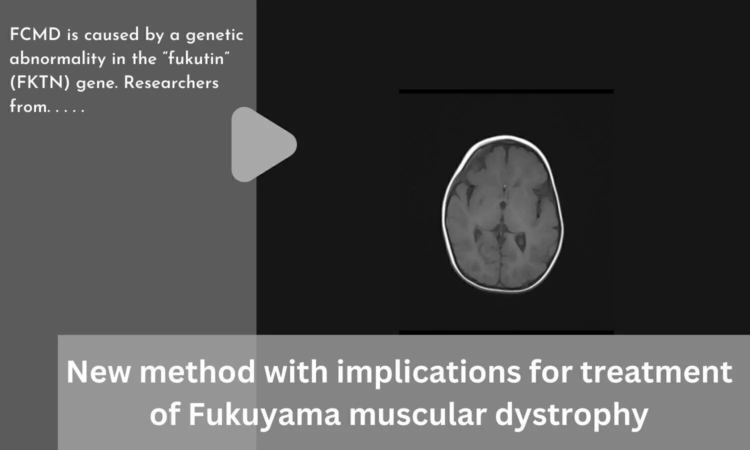 New method with implications for treatment of Fukuyama muscular dystrophy