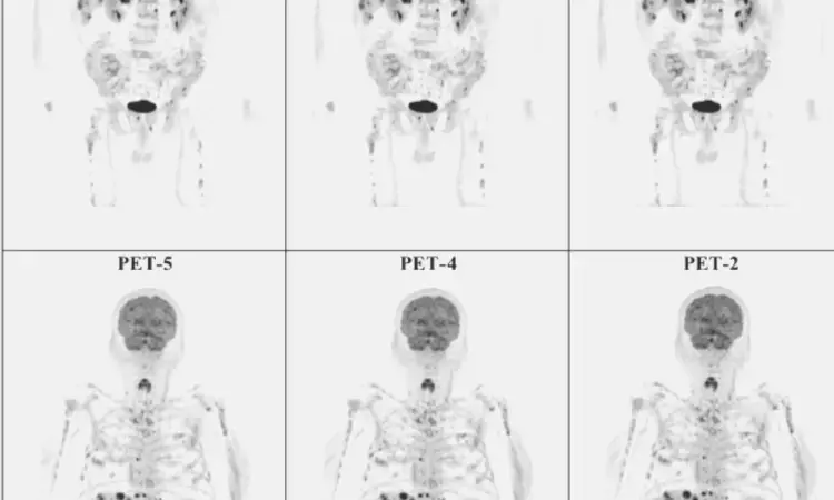 Whole-body PET/CT  reduces total scan time in patients with melanoma: Study