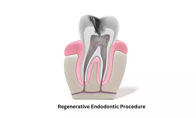 Regenerative endodontic procedures may help detect root canal calcification