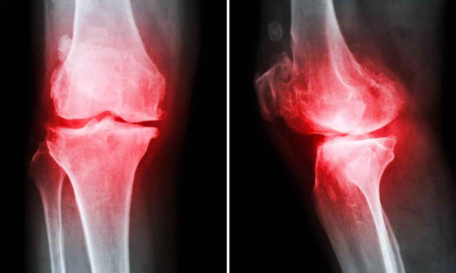 Artificial Intelligence searches an early sign of osteoarthritis from an x-ray image