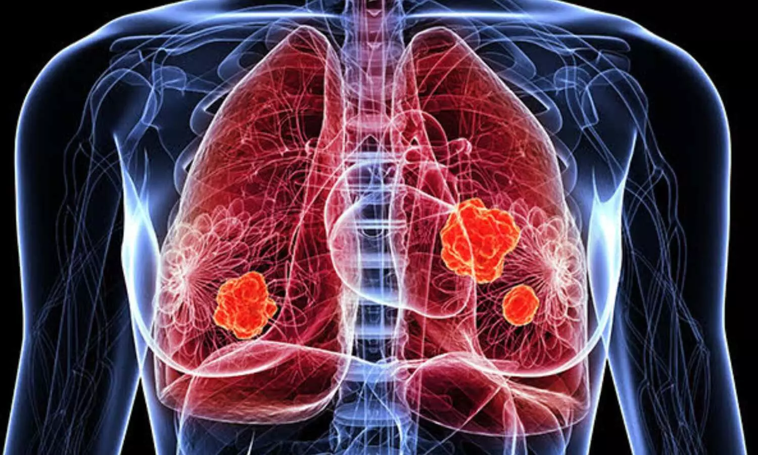 FDA approves glowing tumor imaging agent Cytalux to aid lung cancer surgery