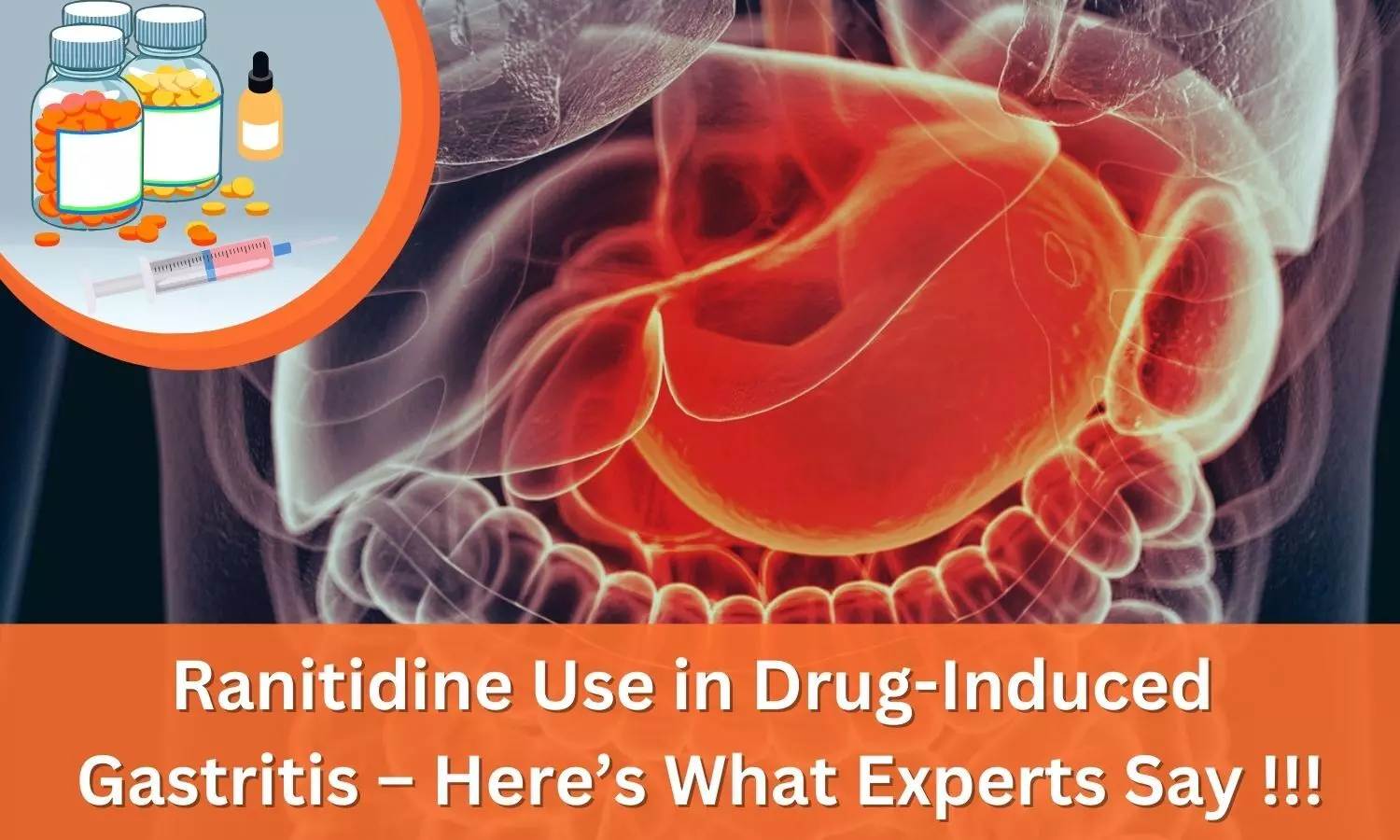 Ranitidine Use in Drug-Induced Gastritis-Heres What Experts Say !!!