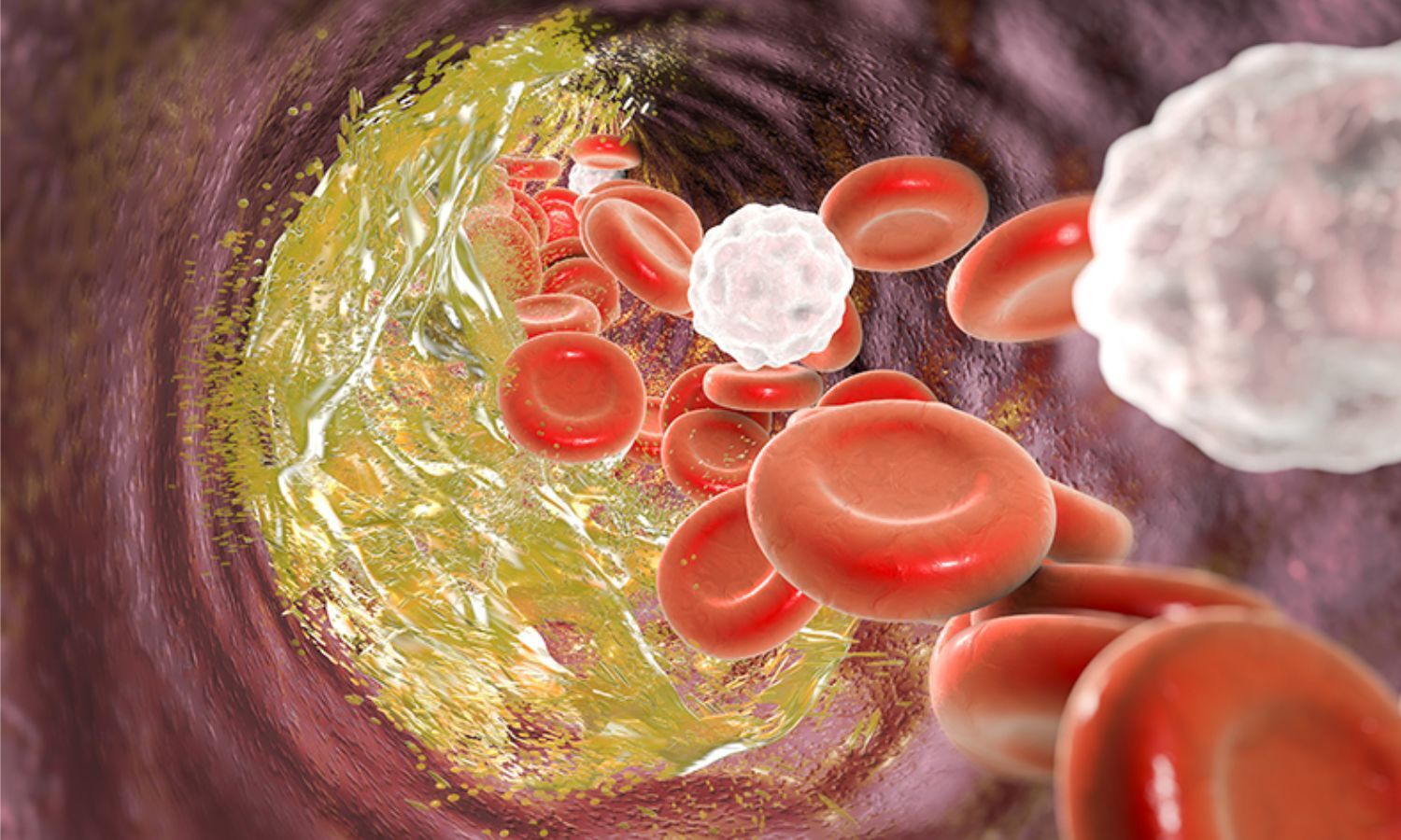 Early Versus Late Chronic Total Occlusion Percutaneous Coronary Intervention: CRM, May 2025 Finds