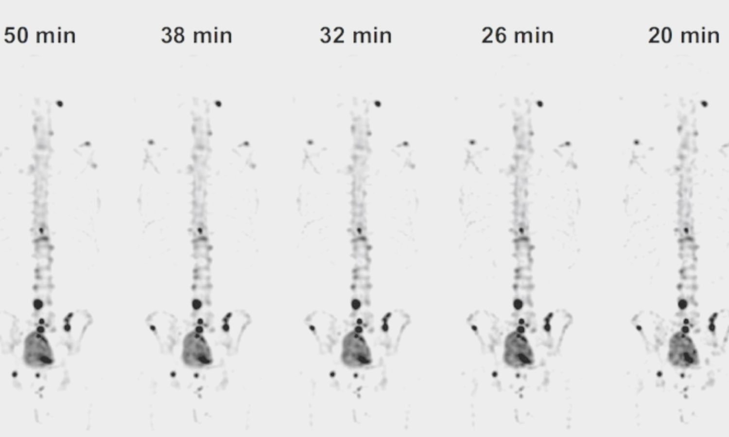 Whole-body SPECT/CT with CZT system significantly cuts scan time for ...