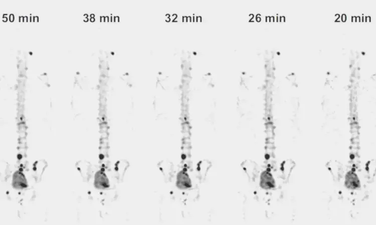 Whole-body SPECT/CT with CZT system significantly cuts scan time for metastases detection in prostate cancer