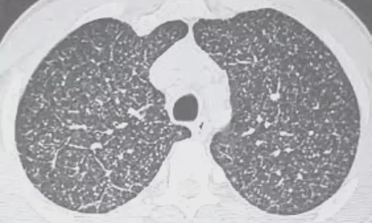 Can CT effectively diagnose interstitial lung disease? Study sheds light