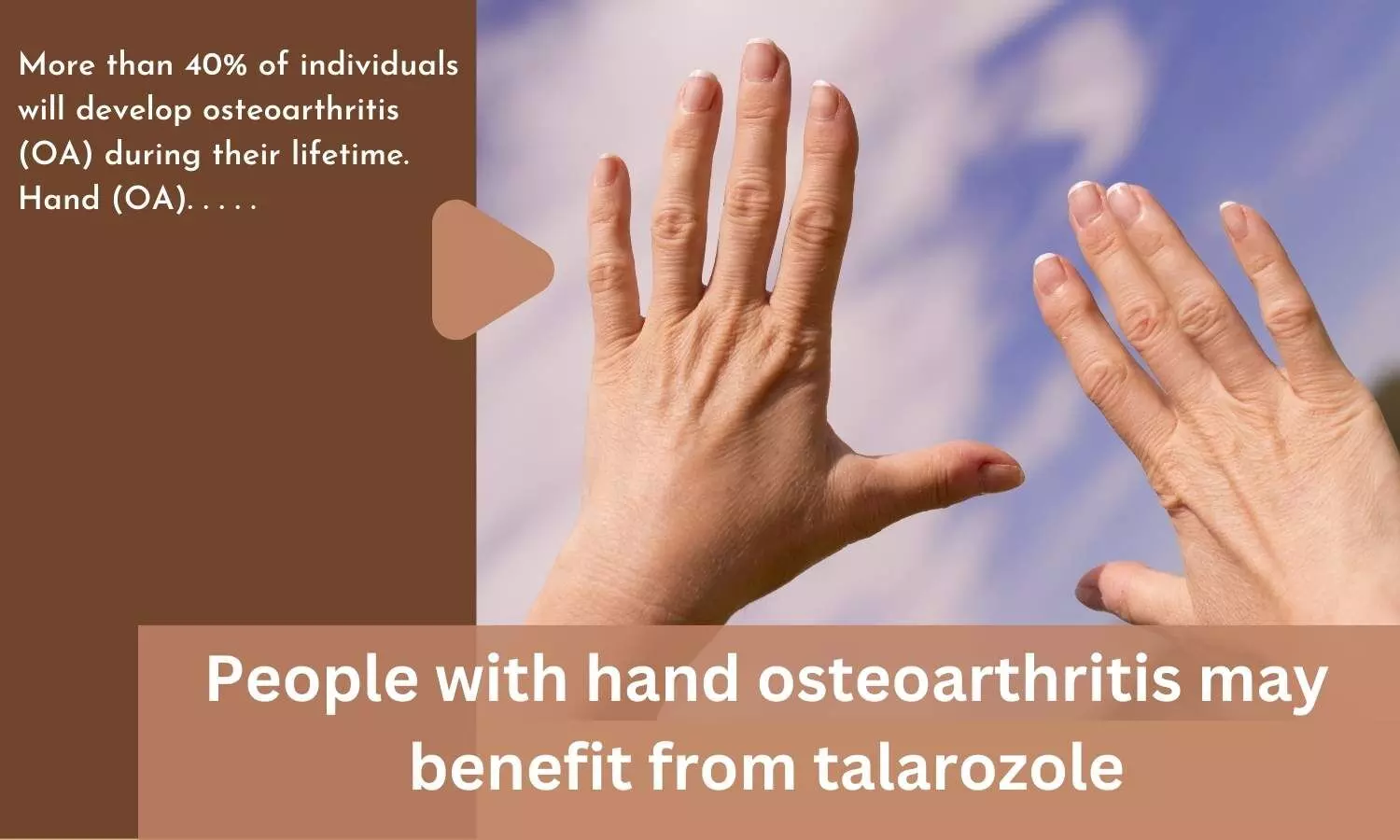 People with hand osteoarthritis may benefit from talarozole