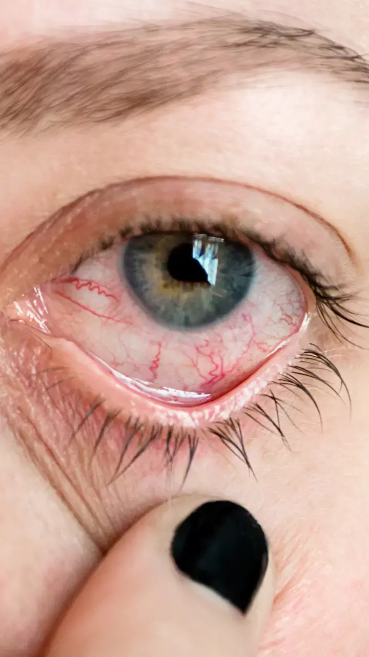 Vision-threatening thyroid eye disease treatment: Discovered in a new study