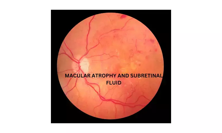 Subretinal fluid protective in macular atrophy in neovascular age-related macular degeneration