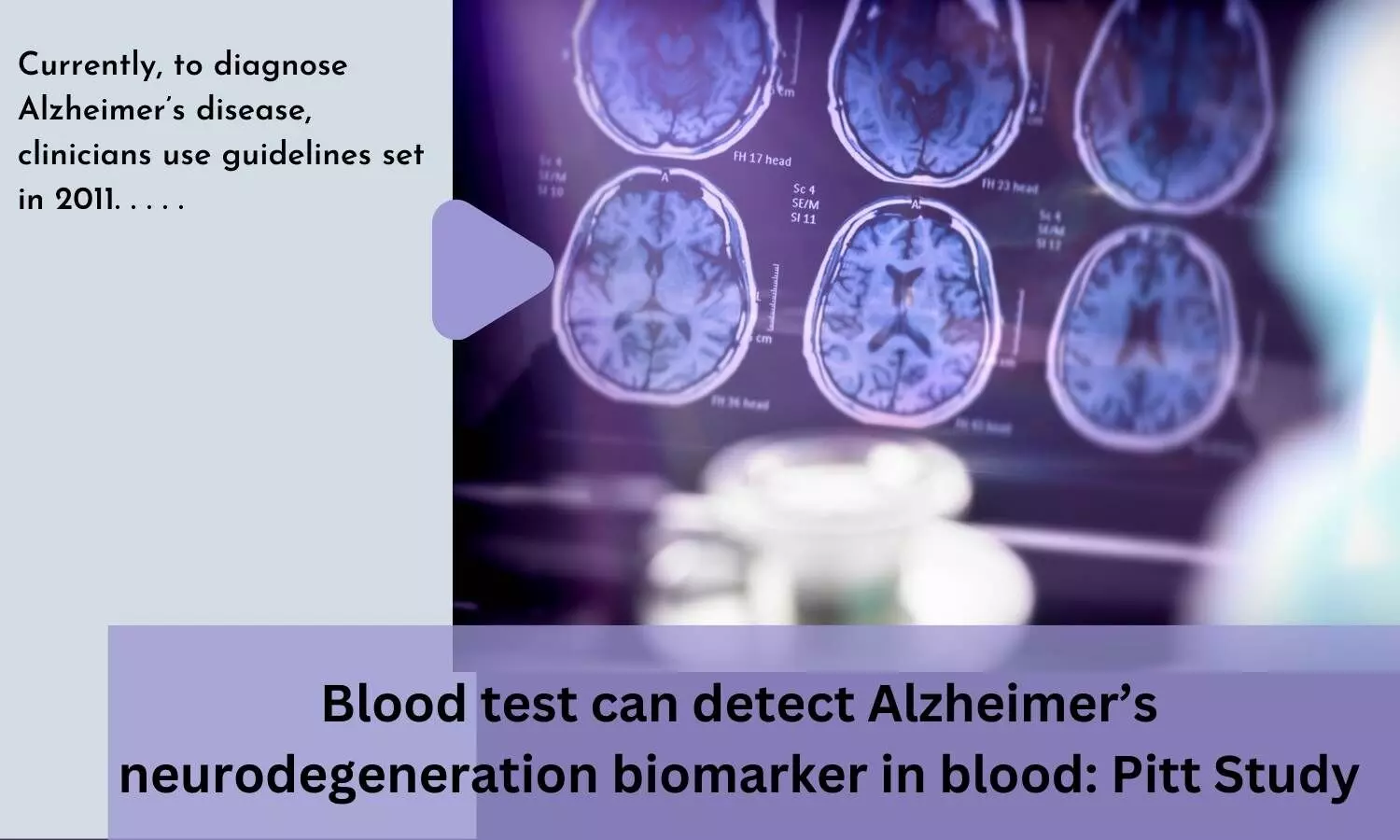 Blood test can detect Alzheimers neurodegeneration biomarker in blood: Pitt Study