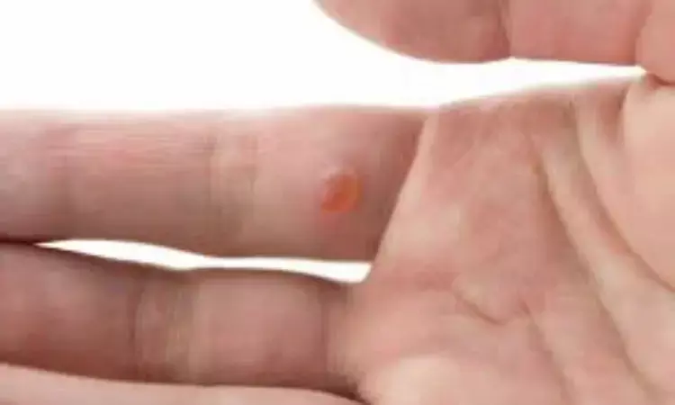 Intralesional Immunotherapy Shows Promising Results for Warts