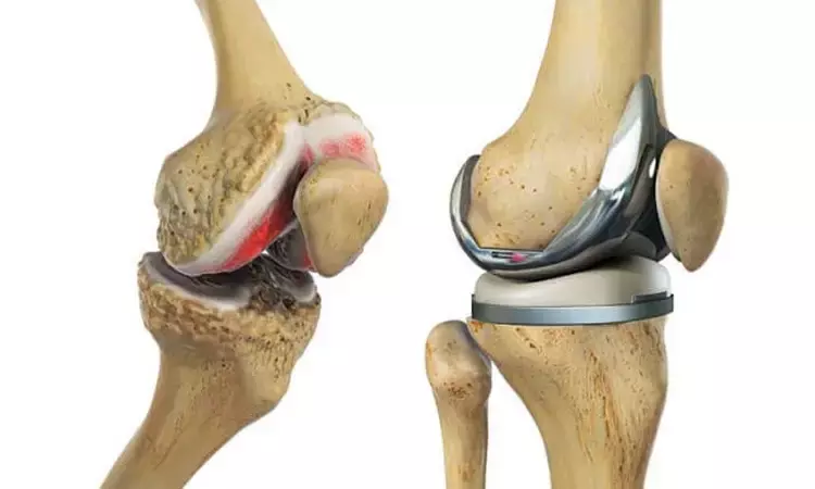 Onlay round and onlay oval patellar implants show better patient-reported outcomes in TKA