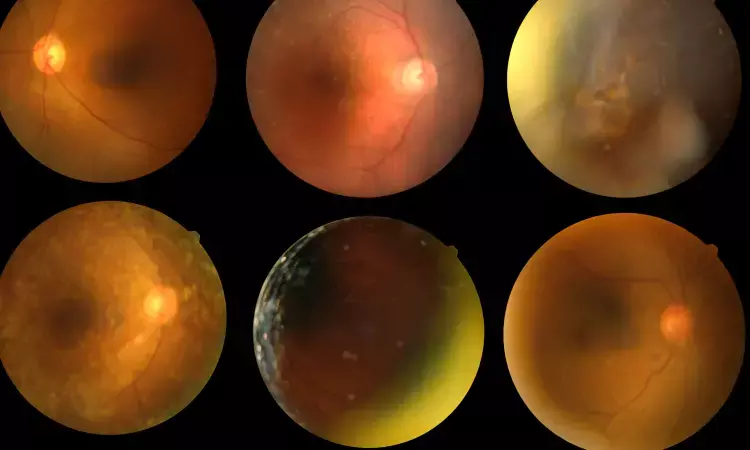 Diabetic Retinopathy associated with Higher Risk of DFU & Amputation in diabetes Patients