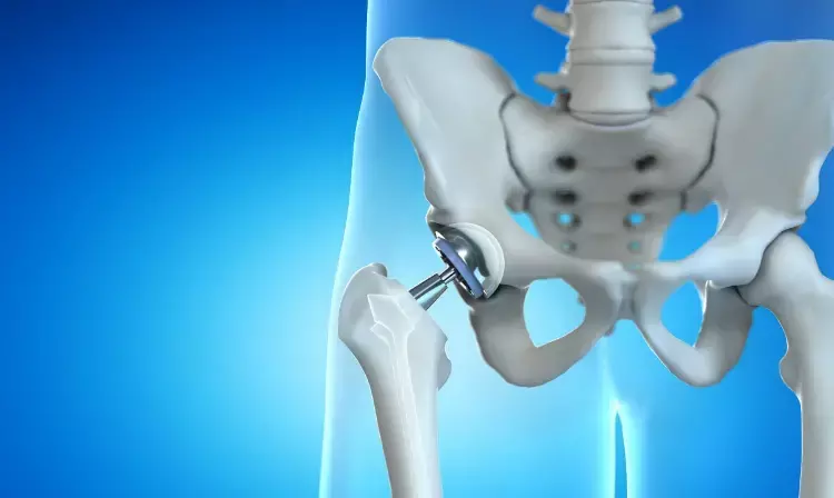 Handheld Navigation Improves Accuracy in Direct Anterior Total Hip Replacement