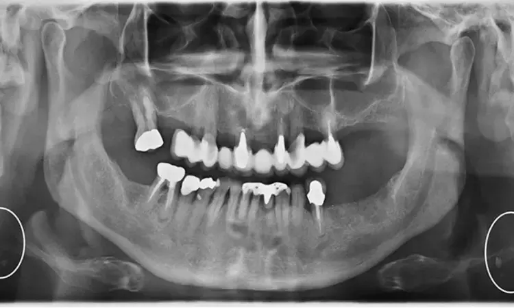 Cone beam CT may incidentally detect calcified head-and-neck atheromas during dental evaluation