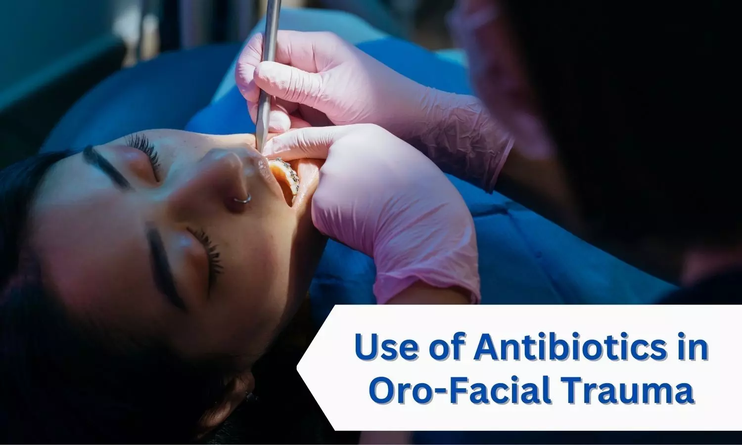 Role Of Systemic Antibiotics in Managing Infection Related to Oro-Facial Trauma