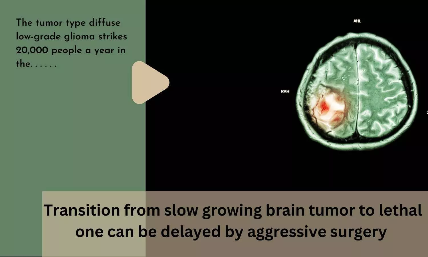 Transition from slow growing brain tumor to lethal one can be delayed by aggressive surgery