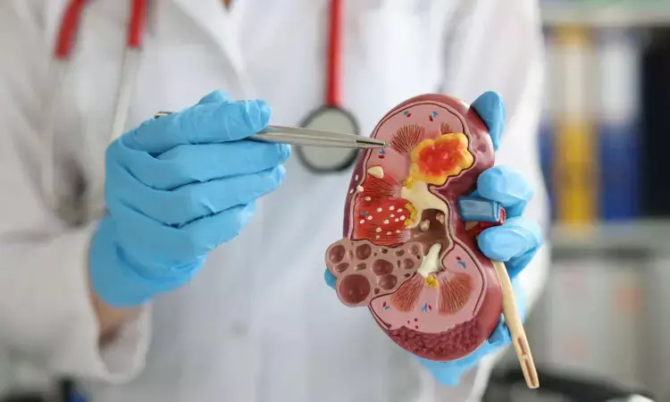 Study shows glucoses role in polycystic kidney disease through   new 3-D model