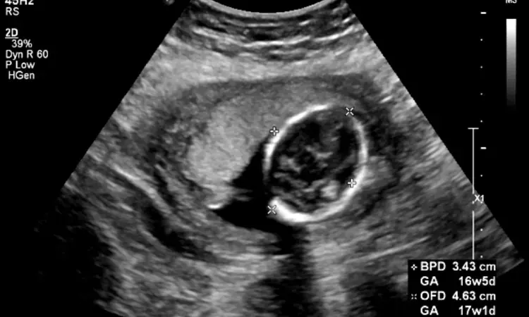 Higher nuchal translucency in ultrasound tied to increased chromosomal anomalies risk: JAMA