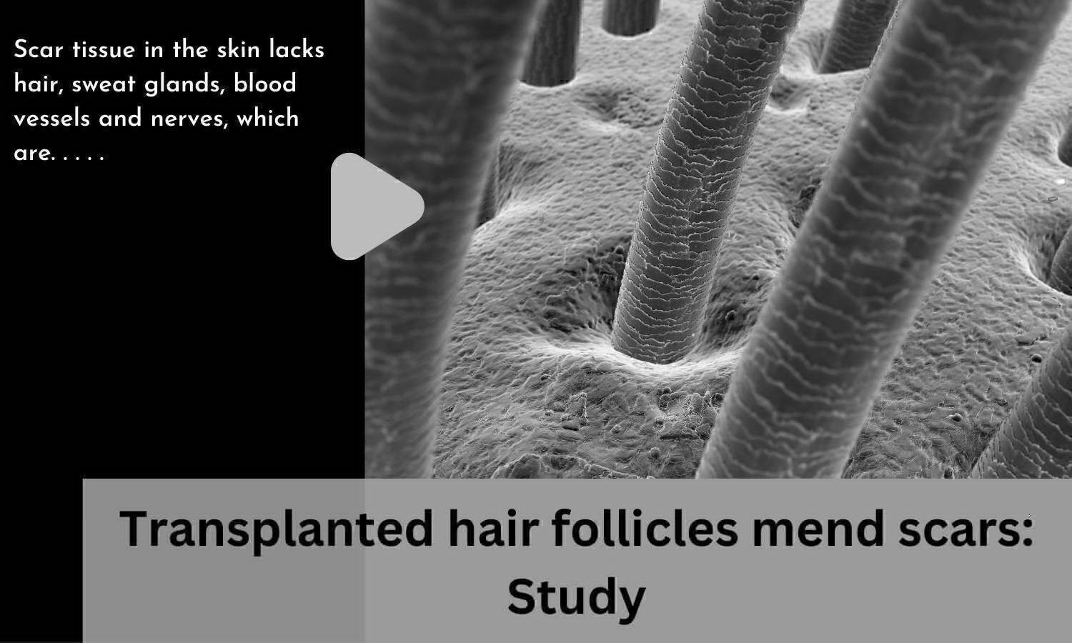 Transplanted hair follicles mend scars Study