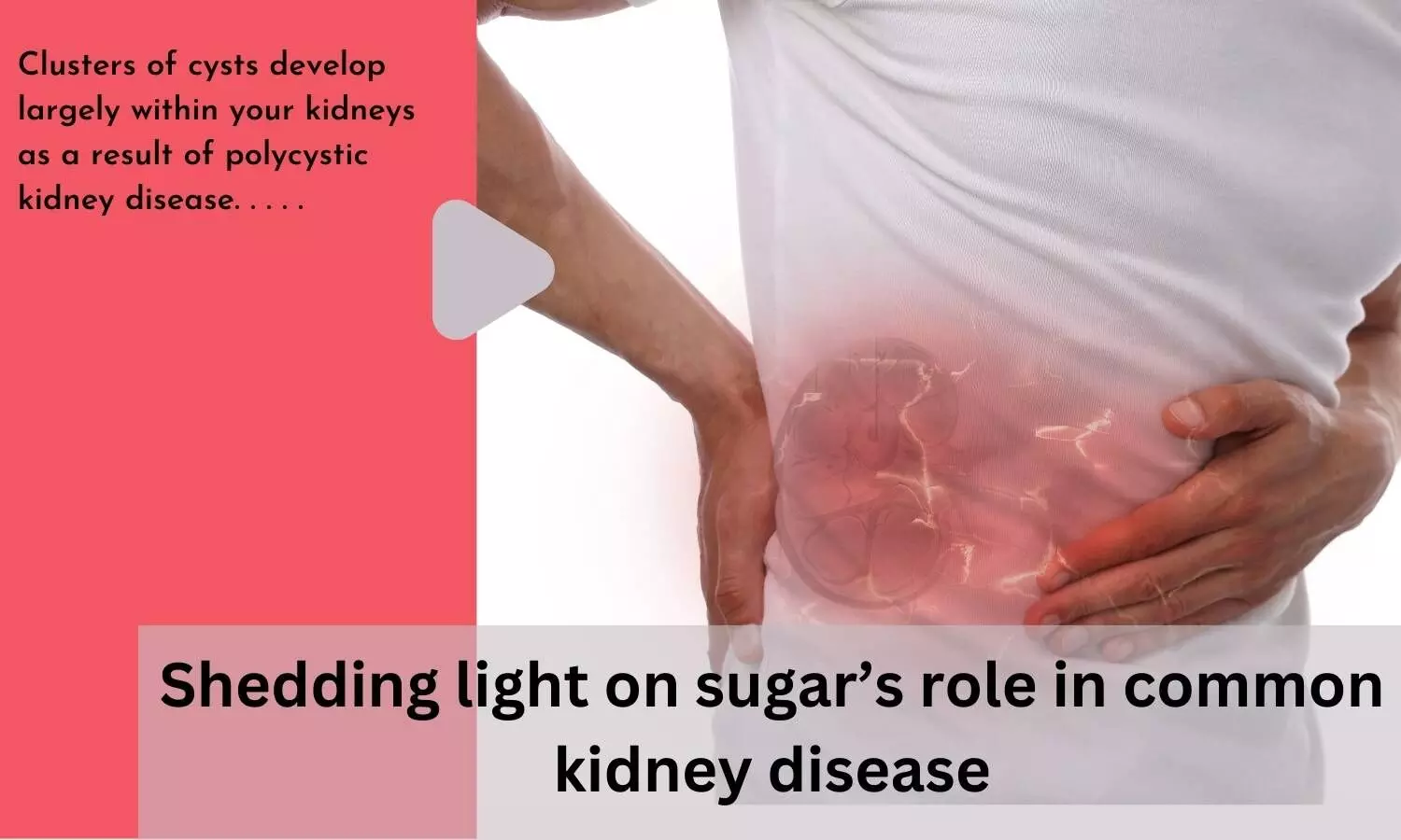 Shedding light on sugars role in common kidney disease