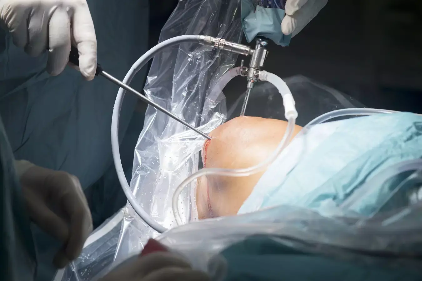 Arthroscopic rotator cuff suture and 360 degree capsular release may improve shoulder movement in rotator cuff tear
