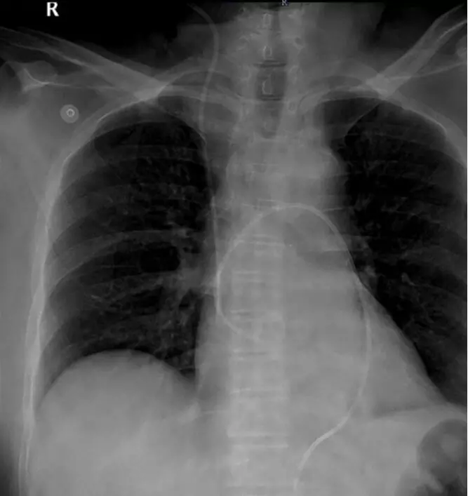 A rare case of spinal tumor syndrome with pericardial effusion