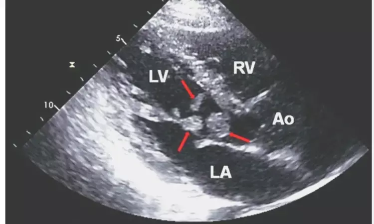 Echocardiographic features of cardiac masses can accurately diagnose malignancy