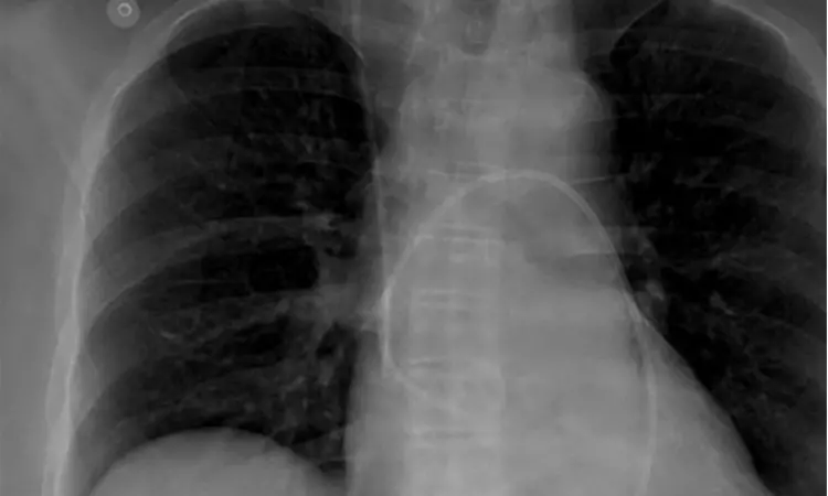 A rare case of spinal tumor syndrome with pericardial effusion