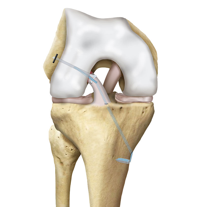 the-anterolateral-ligament-of-the-knee-an-updated-systematic-review-of