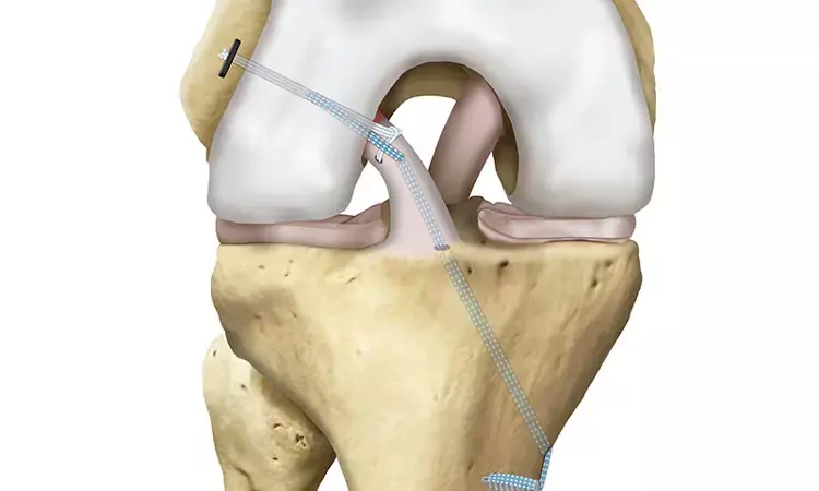 ACL repair with internal bracing effective option to ACL reconstruction for acute proximal tears