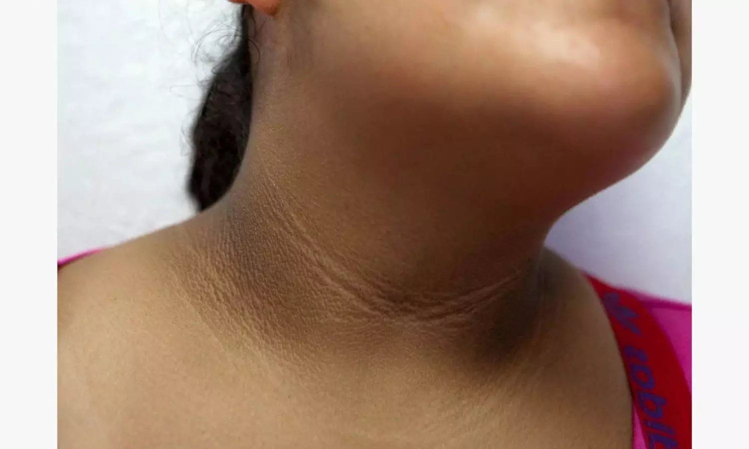 Sirolimus Gel Shows Promise for Acanthosis Nigricans, Suggests Study Sirolimus Gel Shows Promise for Acanthosis Nigricans, Suggests Study