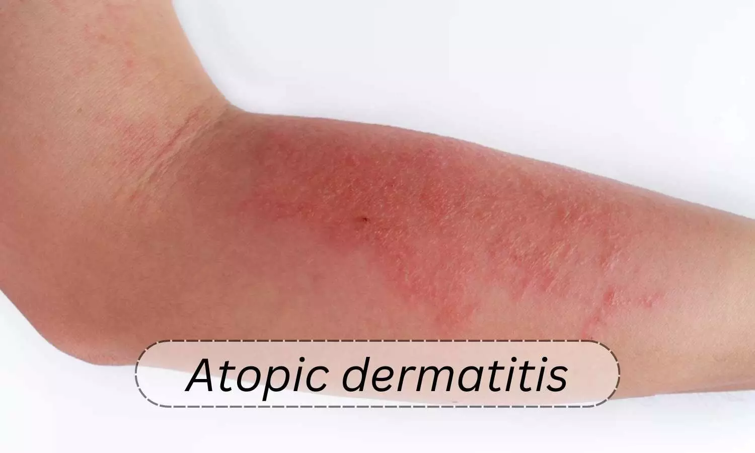 Management of atopic dermatitis  with topical therapies in adults: Updated guideline by AAD