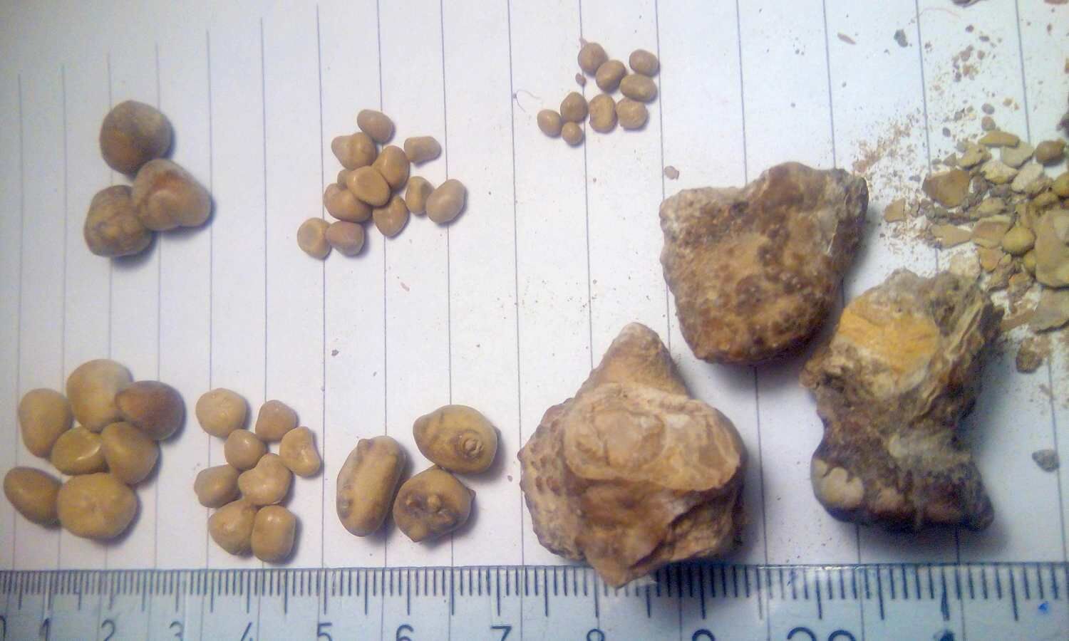 larger-renal-stones-or-positive-urine-nitrite-tied-to-delayed-discharge