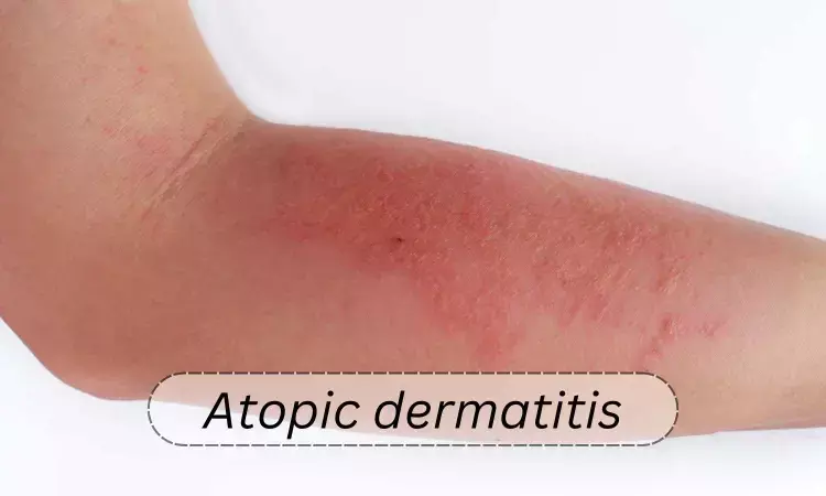 Atopic Dermatitis Linked to Increased Risk of Neuropsychiatric Disorders in Adults