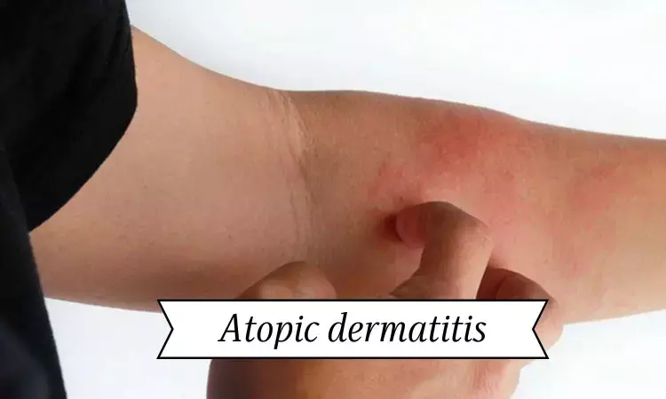 Maintenance dose of lebrikizumab may clear skin and improve symptoms in atopic dermatitis