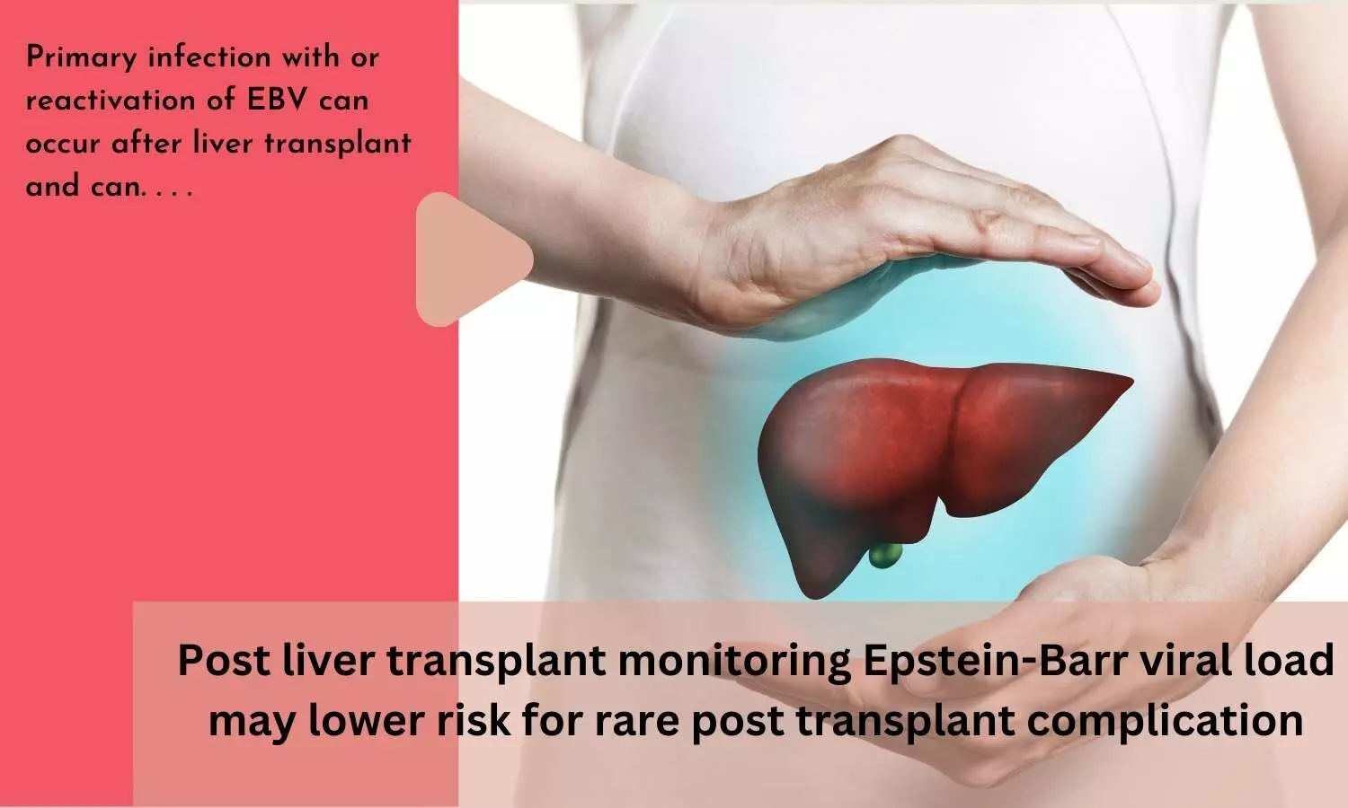 Post liver transplant monitoring Epstein-Barr viral load may lower risk for rare post transplant complication