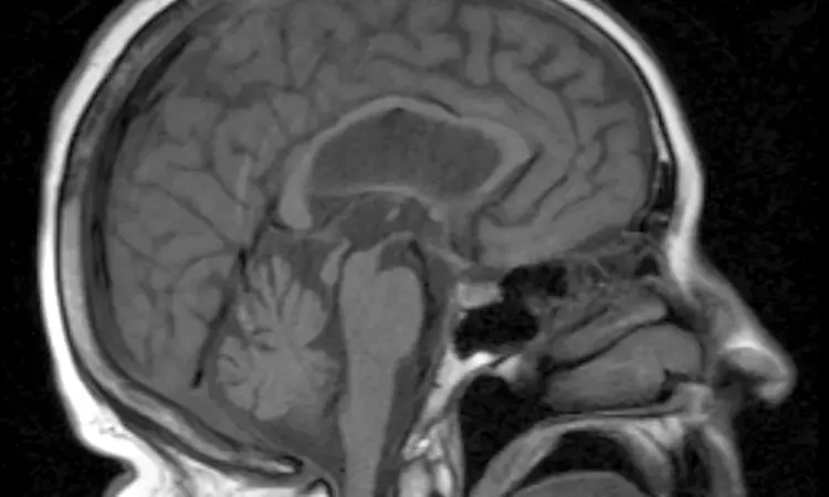 PET imaging with F-18 Florzolotau promising for diagnosing rare brain disorder