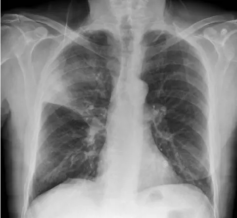 Rare case of  Spherical pneumonia caused by Ralstonia mannitolilytica: A report