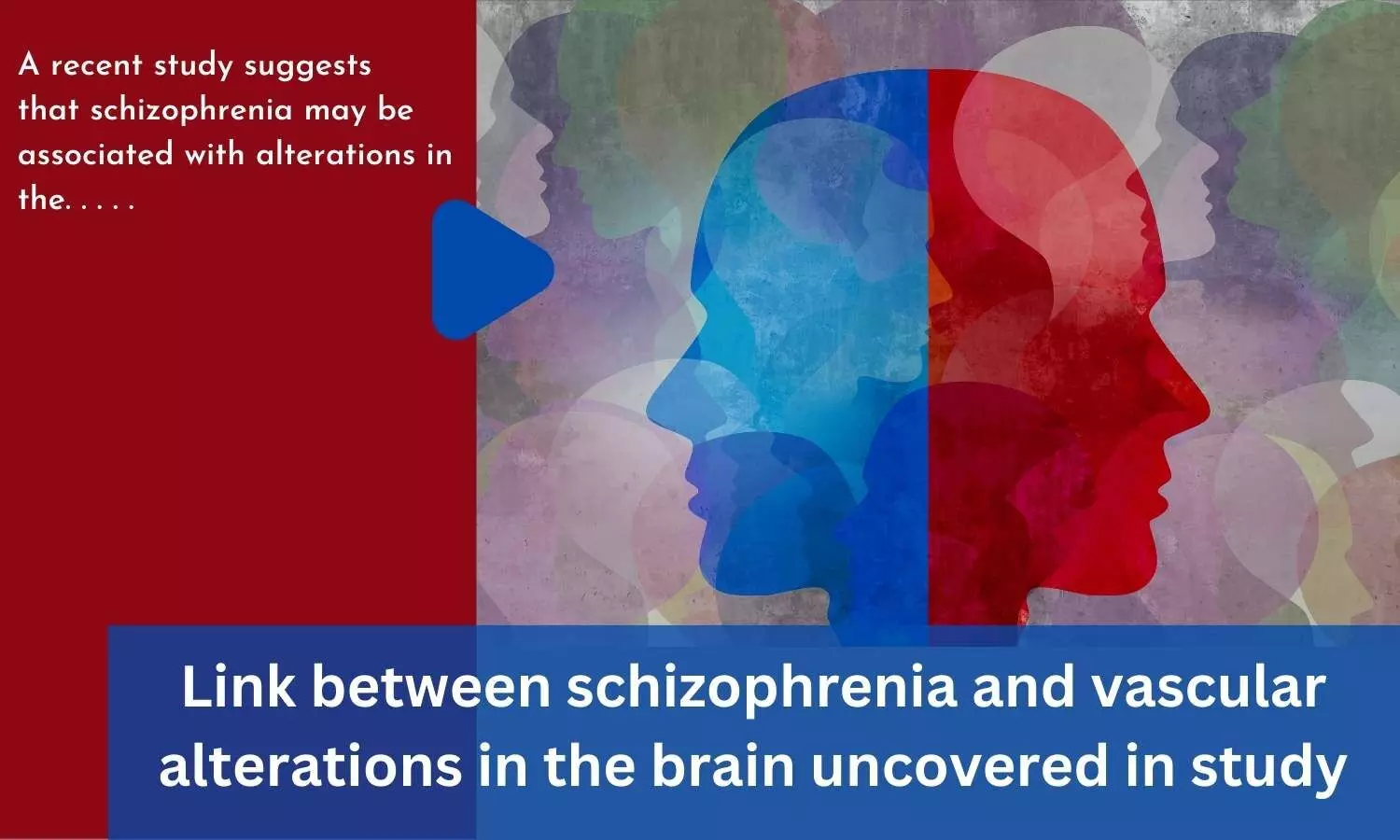 Link between schizophrenia and vascular alterations in the brain uncovered in study