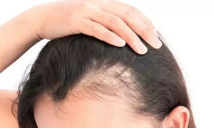 Topical cetirizine shows higher clinical improvement for female androgenetic alopecia