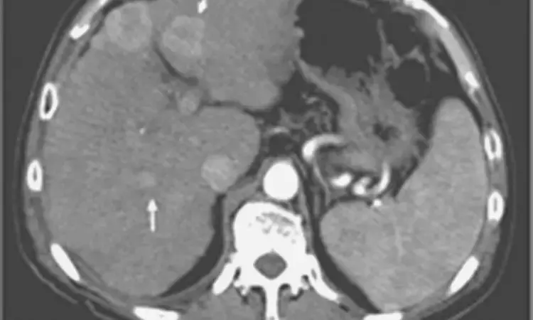 PSMA-PET similar to MRI, superior to CT for liver cancer diagnosis: Study