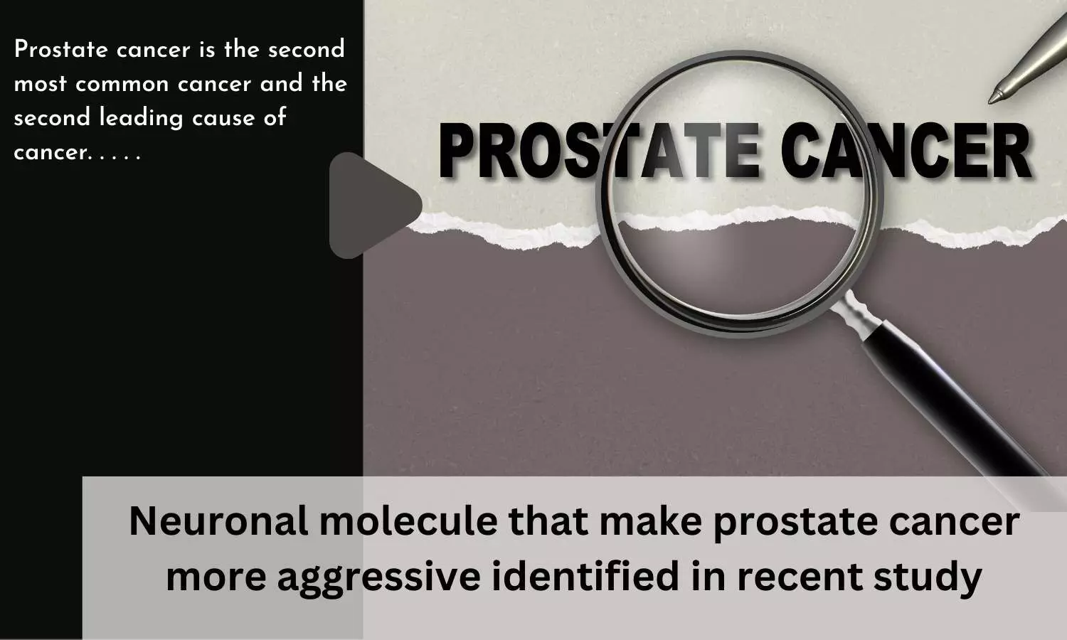 Neuronal molecule that make prostate cancer more aggressive identified in recent study