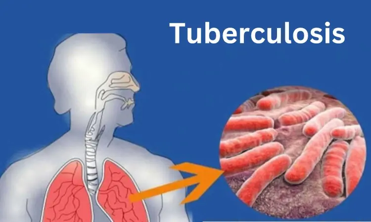 Exposure to indoor smoking, poor household conditions may increase risk of developing pediatric tuberculosis