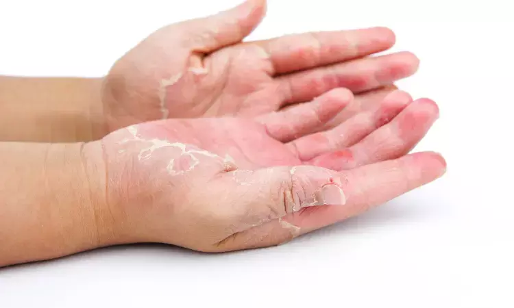 Upadacitinib useful option for managing Atopic dermatitis with concomitant hand eczema