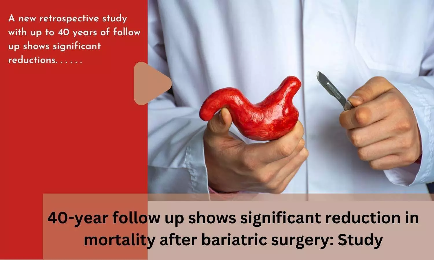 40-year follow up shows significant reduction in mortality after bariatric surgery: Study