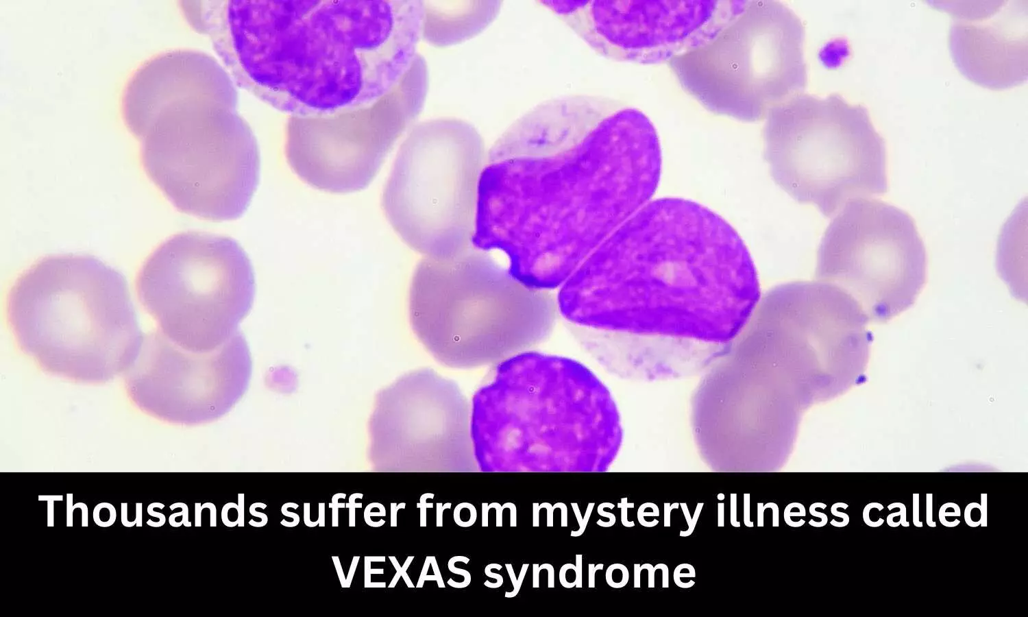 Thousands suffer from mystery illness called VEXAS syndrome