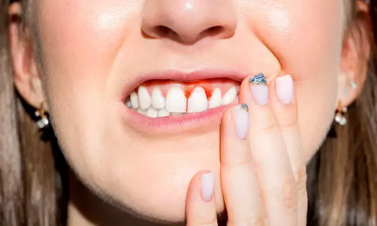 Heavy smoking reduces the benefits of periodontitis treatment: Study