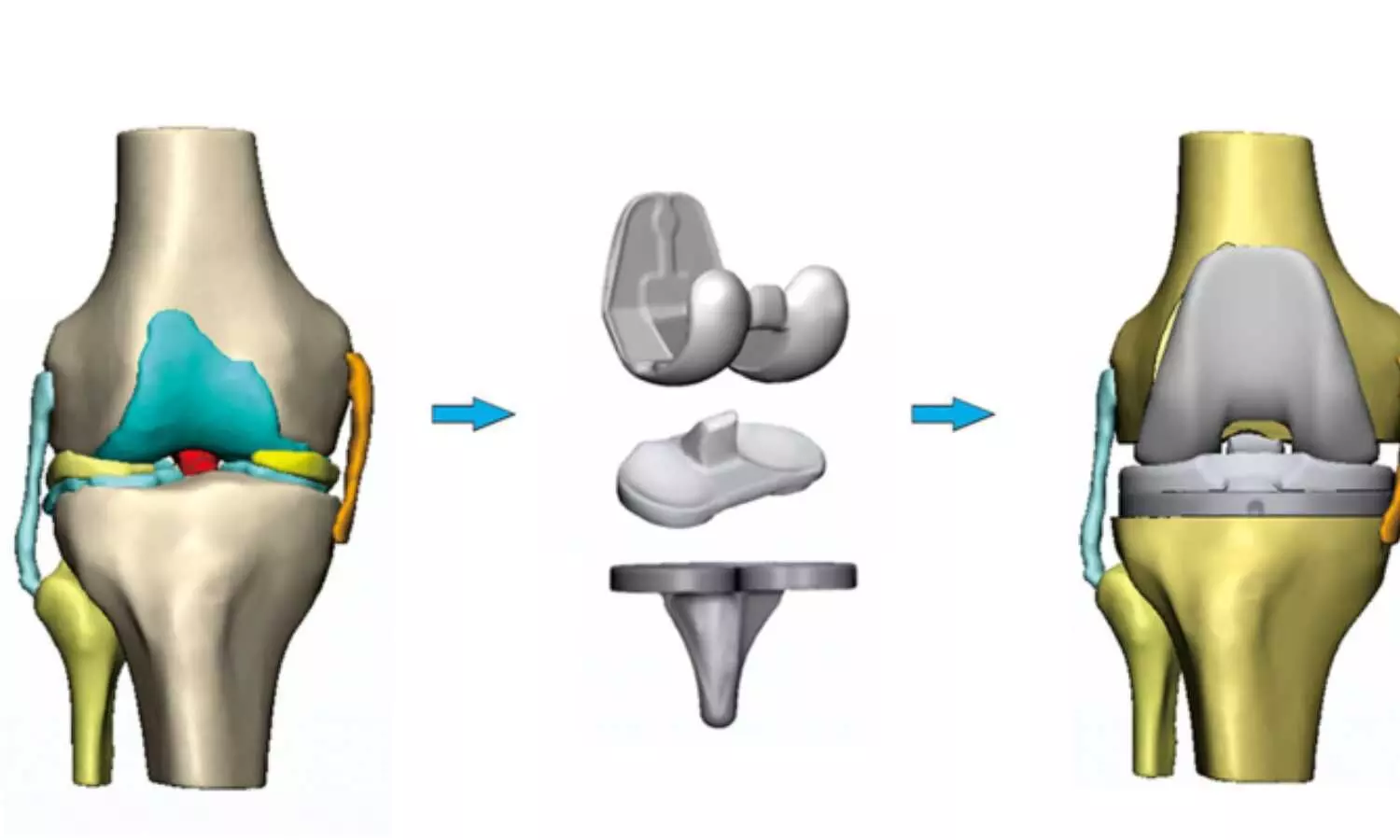 Manual Testing Underestimates Flexion Laxity in Total Knee Arthroplasty, Suggests Study Manual Testing Underestimates Flexion Laxity in Total Knee Arthroplasty, Suggests Study